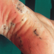 sea urchin wound